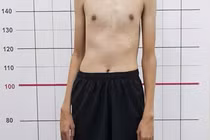 Nam sinh 14 tuổi đã cao gần 2m, bác sĩ chỉ rõ lý do