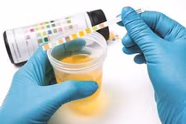 Nước tiểu sẫm màu cảnh báo điều gì về sức khoẻ?