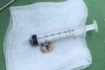 Tím tái vì răng giả rơi vào đường thở trong lúc đang ngủ