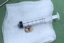 Tím tái vì răng giả rơi vào đường thở trong lúc đang ngủ