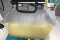 Nghiện rượu, huyết tương trắng đục như sữa 