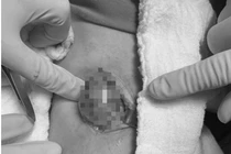 Bác sĩ bóc tách, lấy khối u ra khỏi khoeo chân cho bệnh nhân