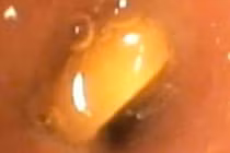 Liên tiếp trẻ nhập viện do hóc dị vật: Cần biết cách xử lý kịp thời