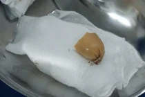 Sau khi ăn sáng với xúc xích, bé gái 13 tuổi nhập viện cấp cứu