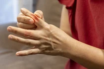 Sưng các khớp ngón tay, phát ban vùng mặt... đi khám mắc bệnh nguy hiểm