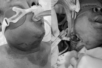 Chủ quan với đau răng... người đàn ông bị sốc nhiễm khuẩn, suy đa tạng