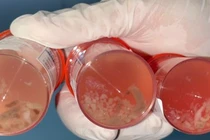 Sút cân, ho, khó thở... bệnh nhân tá hóa khi nhận kết quả nhiễm giun lươn 