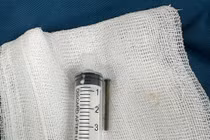 Bé trai 6 tuổi nuốt phải đinh sắt dài 3 cm trong lúc chơi đùa