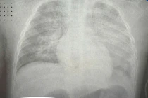 Tưởng sốt ho thông thường, bé 8 tuổi phổi "trắng xóa" sau 6 giờ nhập viện