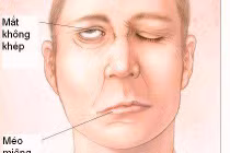 Chủ quan với triệu chứng tê mặt, nam thanh niên bất ngờ bị liệt nửa mặt