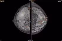 Sờ thấy khối u ở vú phải, đi khám mắc u hiếm gặp