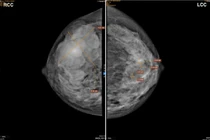 Sờ thấy khối u ở vú phải, đi khám mắc u hiếm gặp