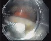 Gắp viên thuốc nguyên vỏ sắc nhọn trong thực quản người đàn ông 67 tuổi