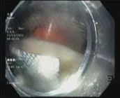 Gắp viên thuốc nguyên vỏ sắc nhọn trong thực quản người đàn ông 67 tuổi