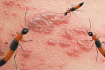 Cần làm gì khi bị kiến ba khoang đốt?