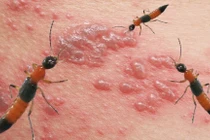 Cần làm gì khi bị kiến ba khoang đốt?