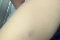 Bé trai 3 tuổi sốc phản vệ sau khi bị ong ruồi đốt