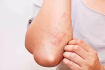 Ngứa, nổi sẩn... cảnh giác với ấu trùng giun đũa từ chó mèo