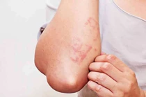 Ngứa, nổi sẩn... cảnh giác với ấu trùng giun đũa từ chó mèo