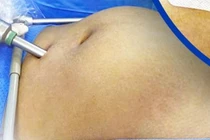 U nang buồng trứng khiến bụng người phụ nữ to như mang thai 4 tháng