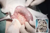 Đau bụng dữ dội kèm theo nôn ói, không ngờ tắc ruột vì bã thức ăn