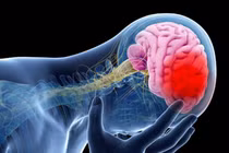 Méo miệng, nói khó... đi khám được chẩn đoán nhồi máu não