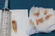 Nuốt nghẹn đi khám phát hiện mảnh xương gà và chiếc răng cửa trong thực quản