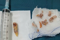 Nuốt nghẹn đi khám phát hiện mảnh xương gà và chiếc răng cửa trong thực quản