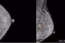 Sờ thấy ngực có khối bất thường, đi khám phát hiện u xơ tuyến vú