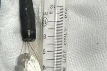 Gắp nắp lon nước ngọt trong dạ dày bé trai 11 tuổi 