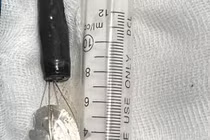 Gắp nắp lon nước ngọt trong dạ dày bé trai 11 tuổi 