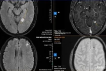 Sán chi chít làm tổ trong não vì... thói quen ăn đồ tái sống