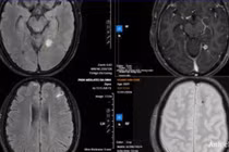 Sán chi chít làm tổ trong não vì... thói quen ăn đồ tái sống
