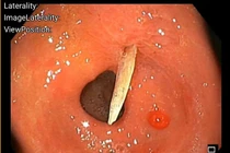 Cụ bà bị xương cá 4cm đâm thủng dạ dày gây phù nề, dịch mủ