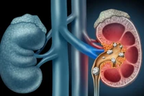 Sỏi thận có thể tự đào thải khỏi cơ thể không?