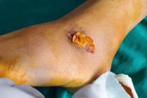 Chủ quan với vết thương nhỏ... bé trai bị suy thận và hàng loạt biến chứng