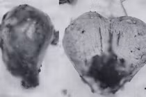 Nguyên nhân bất ngờ khiến người phụ nữ rong huyết nhiều năm