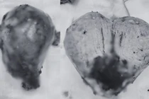 Nguyên nhân bất ngờ khiến người phụ nữ rong huyết nhiều năm