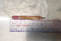 Nghịch dại, bé trai 5 tuổi nhét bút chì vào hậu môn phải cấp cứu