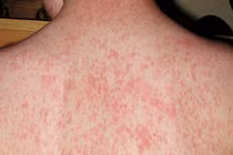 Bé gái 14 tuổi sốt cao, phát ban vì mắc bệnh truyền nhiễm