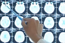 Đau đầu, nhìn 1 thành 2... đi khám bất ngờ phát hiện đột quỵ tuyến yên