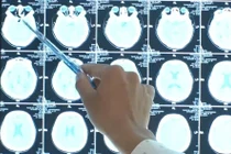 Đau đầu, nhìn 1 thành 2... đi khám bất ngờ phát hiện đột quỵ tuyến yên