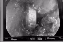 Bé 4 tuổi suýt thủng thực quản vì... pin đồ chơi