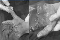 Mất nửa bàn tay do... máy nghiền