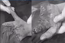 Mất nửa bàn tay do... máy nghiền