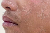 Nam thanh niên bị bỏng độ 2 vì ngủ quên khi tắm nắng