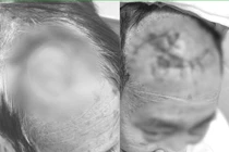 Người đàn ông bị khuyết hổng vùng trán do... chăm sóc vết thương không đúng cách