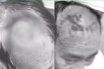 Người đàn ông bị khuyết hổng vùng trán do... chăm sóc vết thương không đúng cách