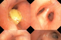 Cụ bà 85 tuổi suýt mất mạng vì... hóc xoài