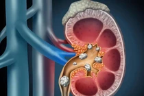 Bụng to dần, kèm đau hông lưng,... đi khám phát hiện thận sưng ứ nước tiểu